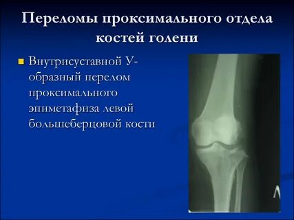 Перелом проксимального отдела большеберцовой кости