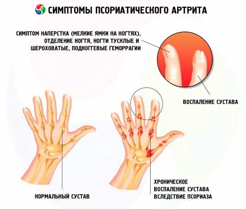 Псориатический артрит симптомы. Клинические проявления псориатического артрита. Характерные суставные проявления ревматоидного артрита. Псориатический артрит поражение суставов.