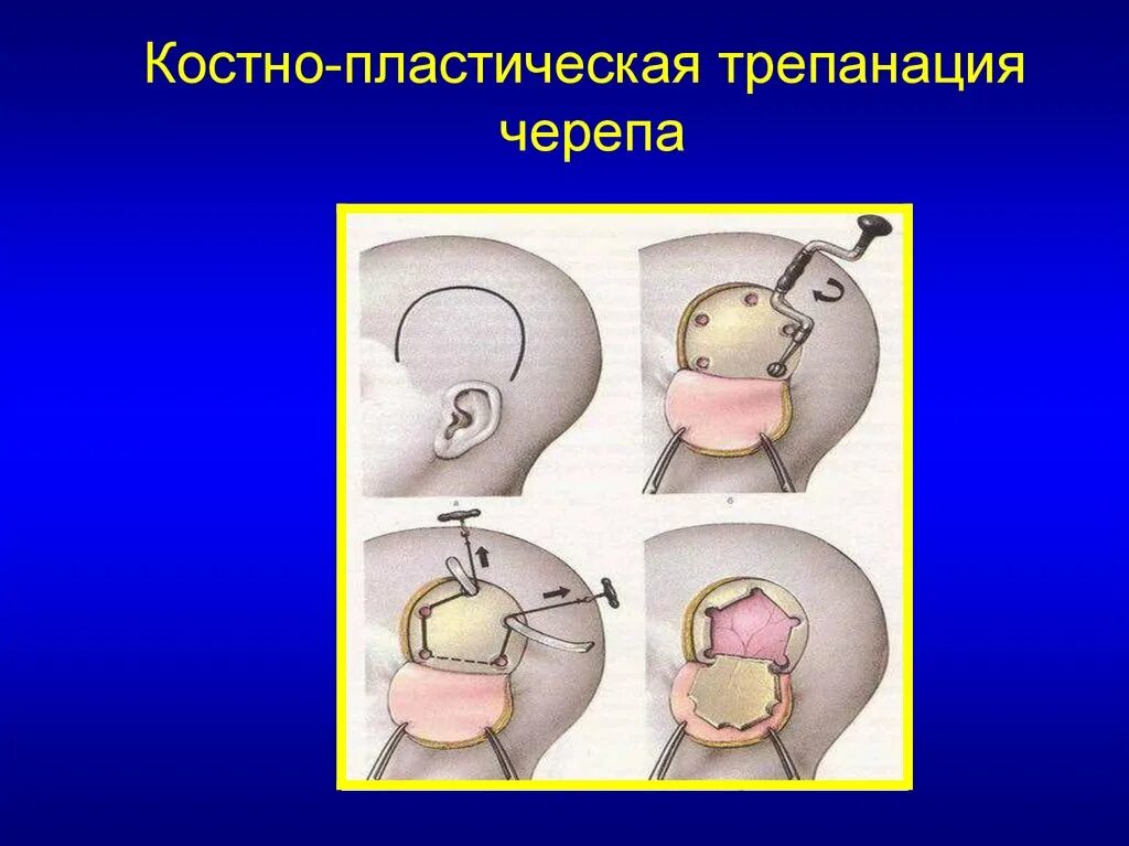 Резекционная Трепанация черепа этапы операции. Декомпрессивная Трепанация черепа. Костно-пластическая Трепанация черепа по Оливекрону. Декомпрессионная Трепанация черепа по Кушингу.