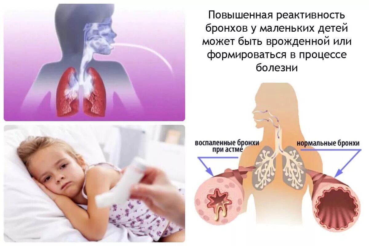 Как развивается астма