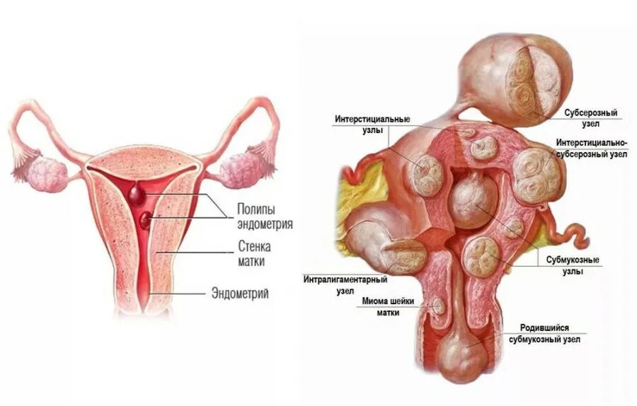 Многоузловая миома матки. Полип в матке или узел миомы. Эндометрический узел матки. Интерстициально субсерозная миома. Эндометрия узлов