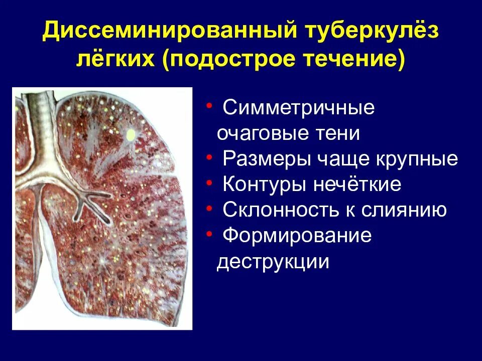 Диссеминированный туберкулез патологическая анатомия. Диссеминированный острый диссеминированный туберкулез. Диссеминированный туберкулез легких подострая форма. Диссеминированный туберкулез легких патанатомия.