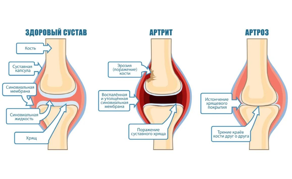Артрит и артроз разница. Артрит и артроз различия. Артрит коленного сустава схема. Отличие артрита от артроза.