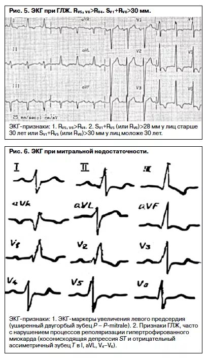 Глж на экг что это значит. Депрессия сегмента St на ЭКГ при гипертрофии. Депрессия сегмента St на ЭКГ. Депрессия сегмента St на ЭКГ У молодых. ЭКГ признаки депрессия St.