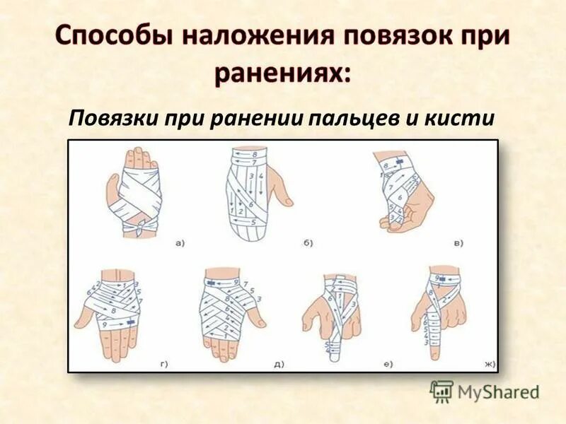 Повязка уздечка алгоритм. Наложение косыночной повязки на верхнюю конечность. Техника наложения повязок. Пращевидная повязка на подбородок. Наложение повязки уздечка алгоритм.