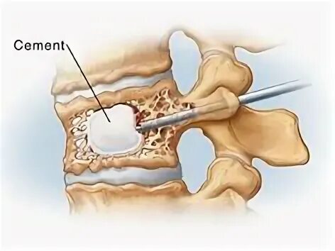 Цемент костный эндопротезирование. Ревисион атлантик лекарство. Ash and bone. Сосуд для смешивания костного цемента. Bone cement.