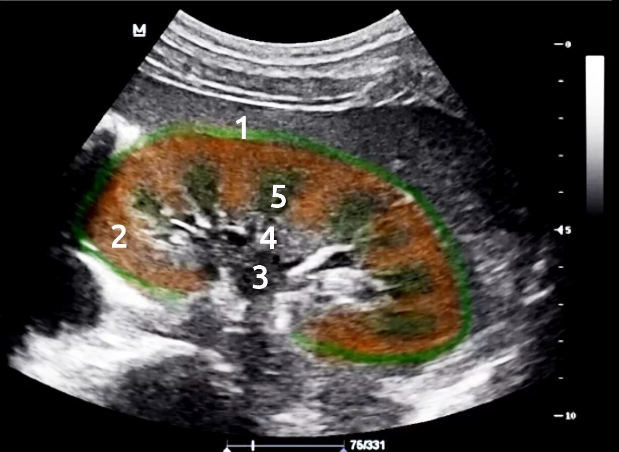 Паренхима почки на УЗИ. Анатомия почки на УЗИ почек. Изменение паренхимы почки на УЗИ. Микрокальцинаты в почках на УЗИ.