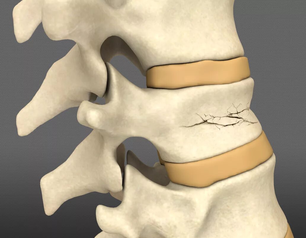 Fracture c