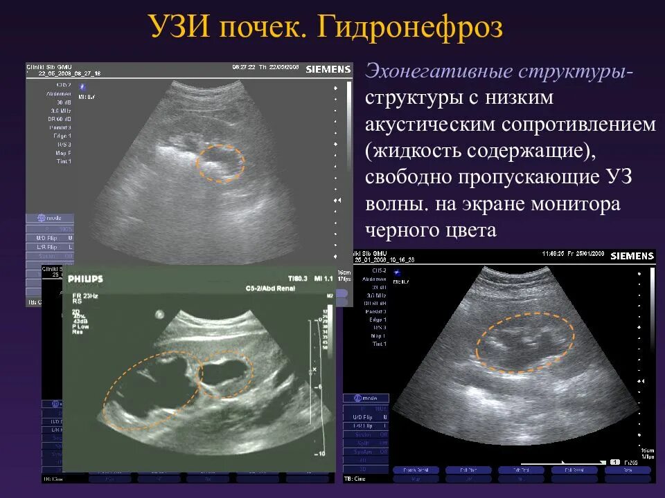 УЗИ почек гидронефроз 1ст. Гидронефротическая трансформация почки на УЗИ. УЗИ признаки гидронефроза почек. УЗИ почек гидронефроз заключение. Узи почек на голодный