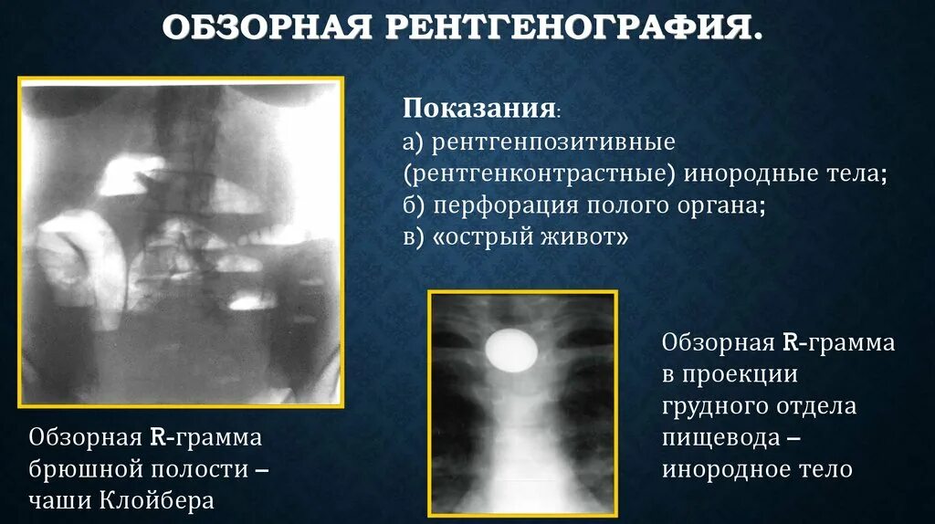 Инородное тело брюшной полости после операции. Рентгенологические методы исследования органов брюшной полости. Рентген брюшной полости в боковой проекции. Обзорная рентгенография брюшной полости чаши Клойбера.