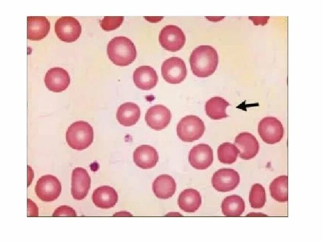 Дефицит глюкозо-6-фосфат дегидрогеназы. Тельца Гейнца Эрлиха. Эритроциты при дефиците глюкозо-6-фосфатдегидрогеназы. Тельца Гейнца в эритроцитах. Тельце гейнца