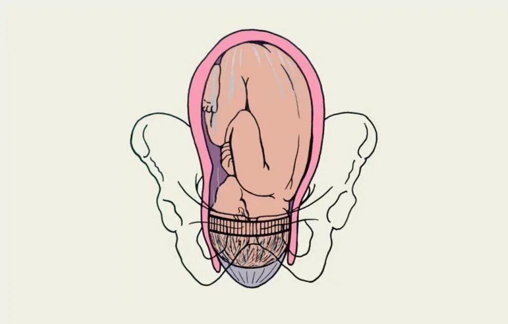 32 недели схватки. Низкое расположение головки плода на 32 неделе беременности. Опускание плода в малый таз. Низко расположена головка плода.