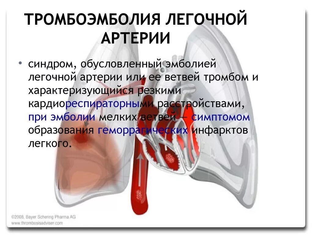 Тромбоэмболия легочной мелких артерий. Массивная тромбоэмболия мелких лёгочных артерий. Тромбоэмболия легочной артерии. Тромболия легочной артерии. Тромбоэмболия легочной артерии (Тэла).