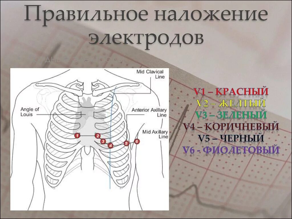 Как ставить электроды