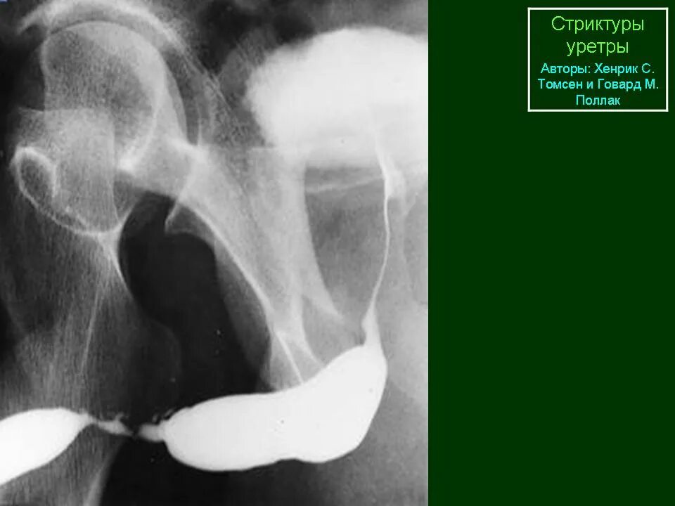 Стриктура уретры уретрограмма. Стриктура бульбозного отдела уретры. Стриктура бульбозного отдела уретры рентген. Ретроградная уретроцистография.