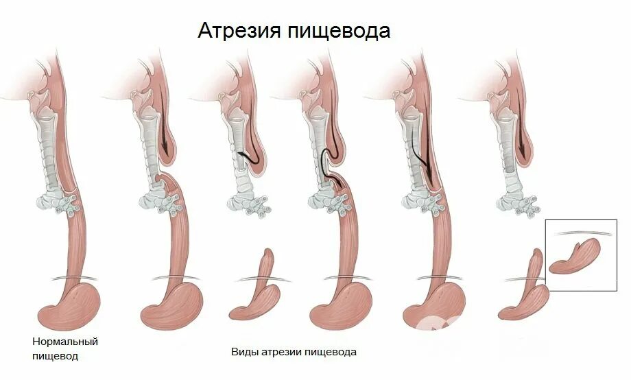 Атрезия пищевода детская хирургия. Классификация атрезии пищевода у детей. Атрезия пищевода с трахеально-пищеводным свищом. Атрезия пищевода у новорожденных операция. Слепой пищевод