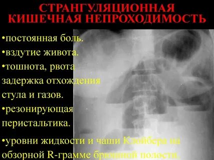 Непроходимость желудка симптомы