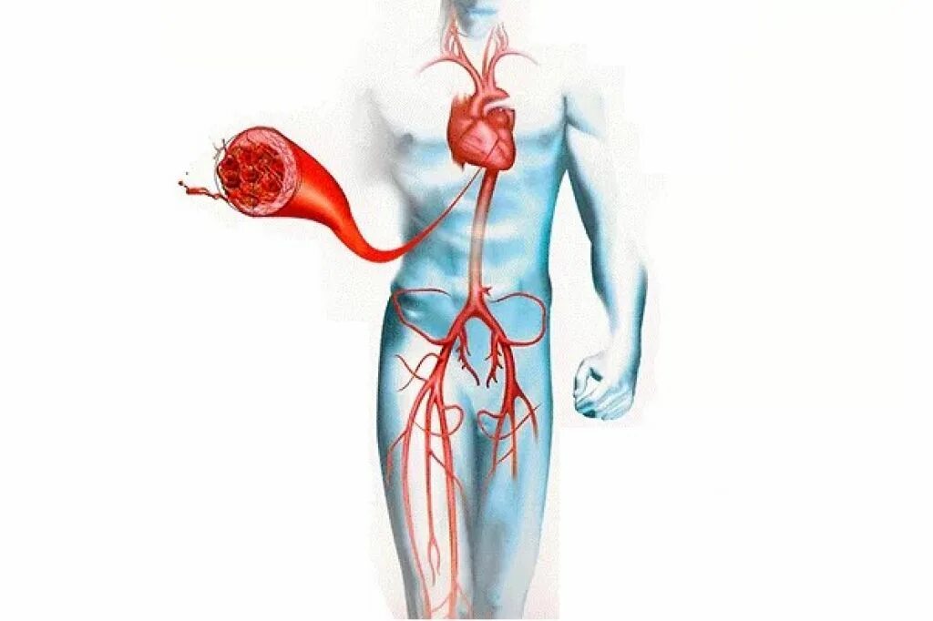 Тромбоз артерии лечение. Тромбоз артериальных сосудов.
