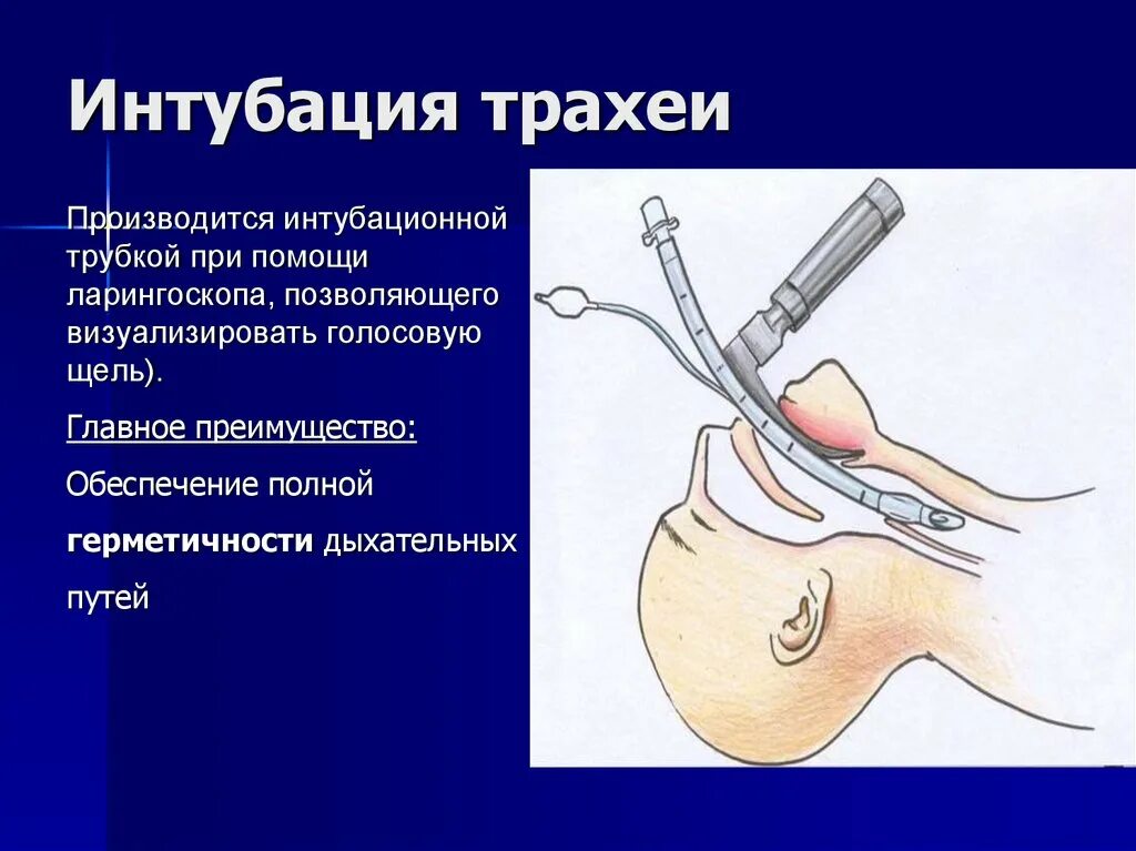 Набор для интубации трахеи методом прямой ларингоскопии. Интубация трахеи методом прямой ларингоскопии. Техники интубации трахеи. Интубация трахеи методика.