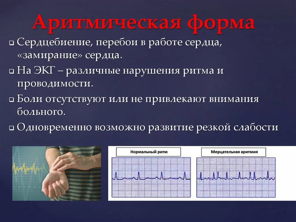 Аритмическая форма инфаркта миокарда. Аритмическая форма инфаркта миокарда симптомы. Клиника аритмического инфаркта миокарда. Перебои в работе сердца при инфаркте миокарда.