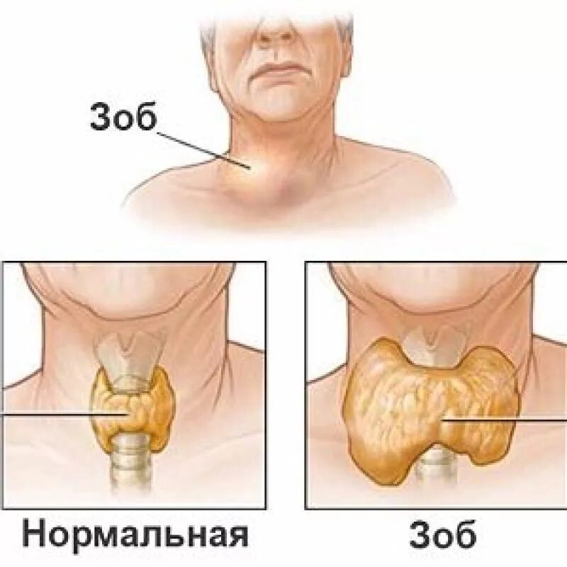 Где зоб. Эндемический зоб щитовидной. Многоузловой эндемический зоб. Узловой зоб 2 степени щитовидной железы симптомы. Узловой эндемический зоб.