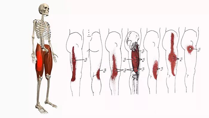 Болит бедро и поясница. Триггерные точки поясничной и ягодичной области. Подвздошно-поясничная мышца триггерные точки. Миофасциальный синдром подвздошно-поясничной мышцы. Миофасциальный синдром тазобедренного сустава.