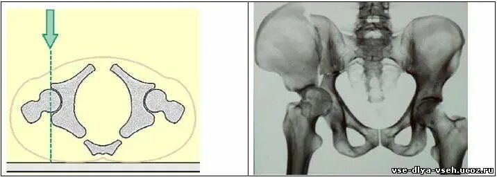 Перелом впадины тазобедренного сустава. Краевой перелом вертлужной впадины слева. Перелом края вертлужной впадины рентген. Перелом вертлужной впадины рентген. Остеосинтез вертлужной впадины.