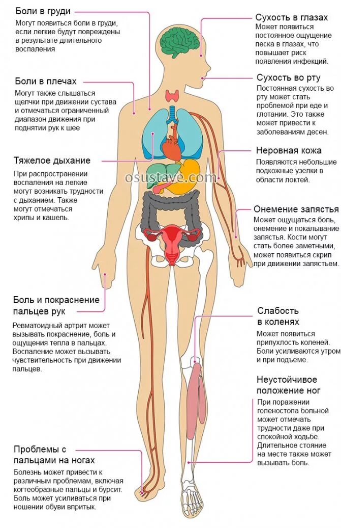 Ревматоидный артрит симптомы и признаки у мужчин
