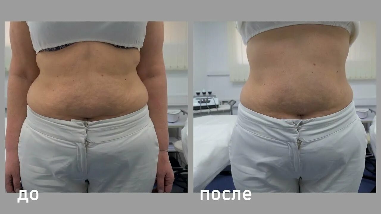 Рф живота отзывы. Liposonix Липосоникс. Кавитация липолиз. Ультразвуковая кавитация до и после. Микроигольчатый RF-лифтинг живота.