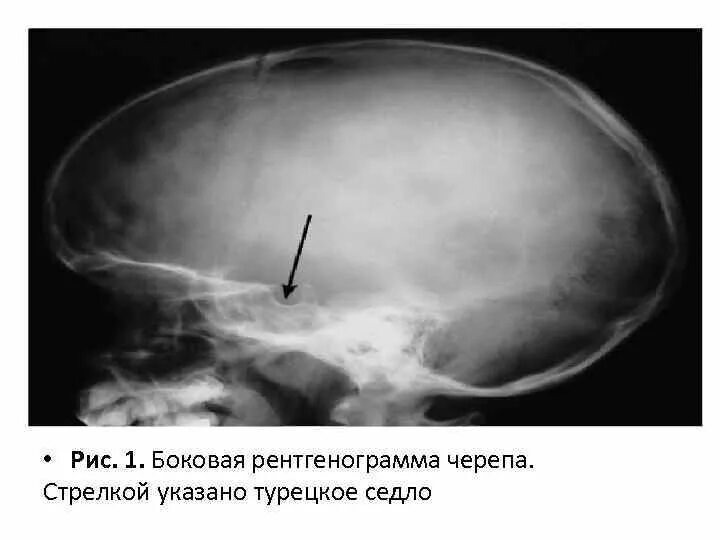 Образование турецкого седла. Рентген черепа гипофиз. Рентген черепа турецкое седло. Рентген гипофиза турецкого седла. Аденома гипофиза рентген черепа.