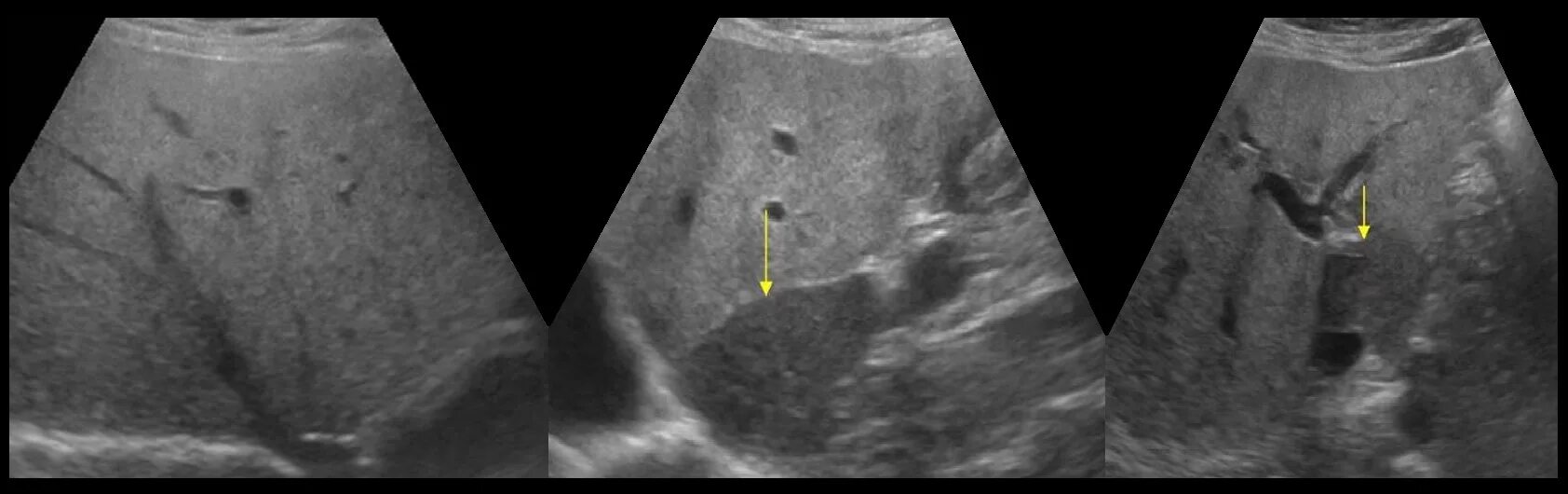 Протоковые изменения в печени. УЗИ поджелудочной железы Изранов. УЗИ печени Изранов. Диффузные изменения печени на УЗИ. Жировой гепатоз печени на УЗИ.