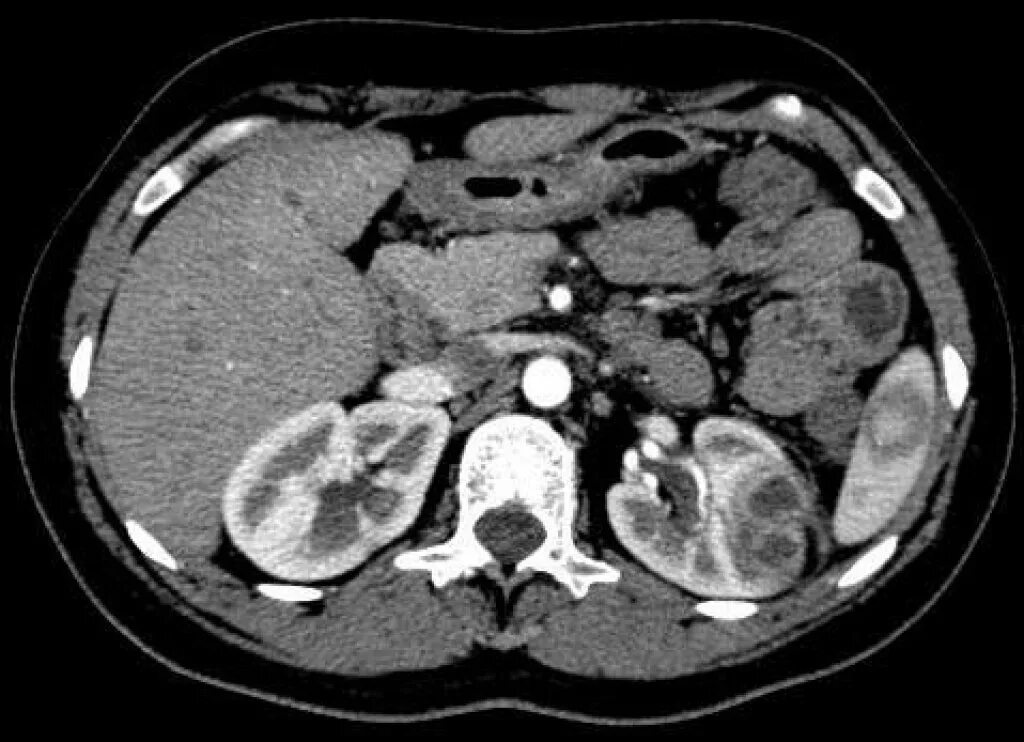 Пиелонефрит паранефрит кт. Апостематозный нефрит на кт.