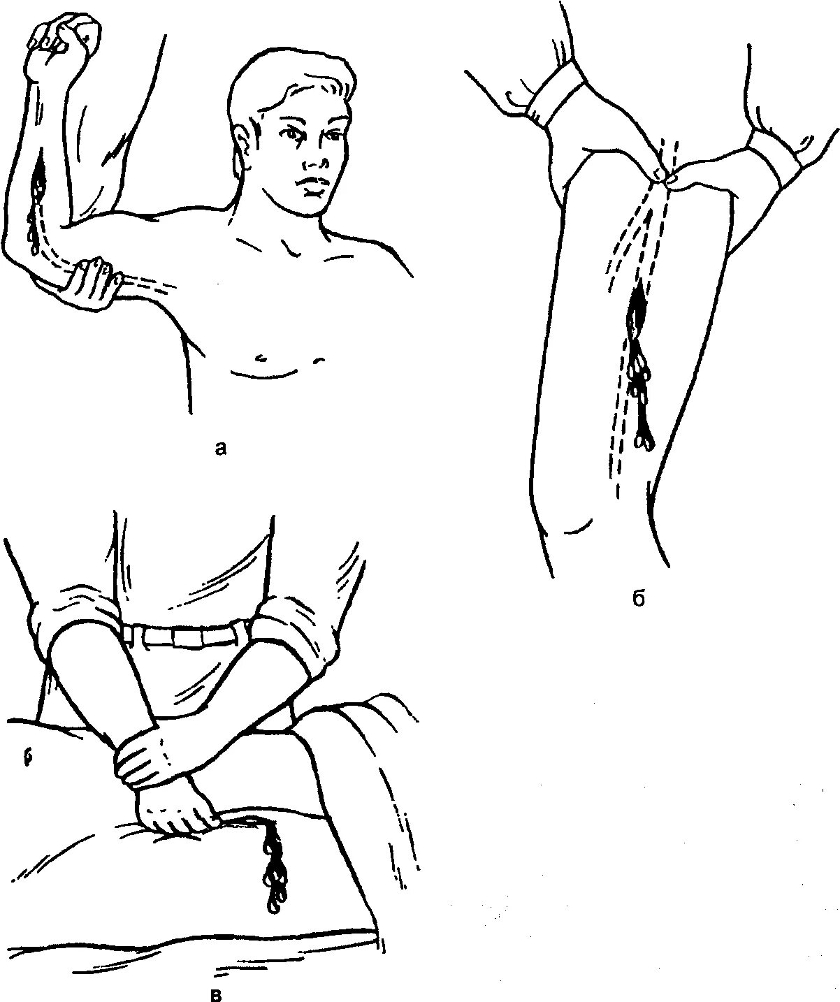 Способы остановки кровотечения пальцевое прижатие артерии. Остановка кровотечения методом пальцевого прижатия. Пальцевое прижатие бедренной артерии. Остановка кровотечения из плечевой артерии пальцевое прижатие. Пережатин бедренной артерии.