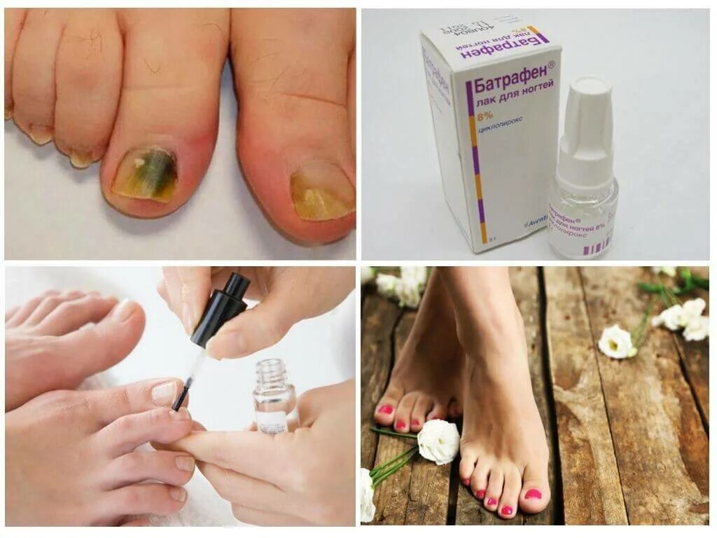 Эффективное лечение грибка ногтей рук. Средство от грибка ногтей. Антигрибковое средство для ногтей на ногах. Средство от грибка ногтей на ногах.