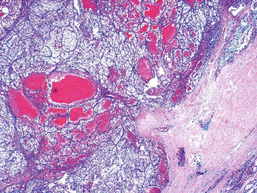 Светлоклеточная аденома почки гистология. Карцинома почки гистология. Почечно клеточная карцинома. Светлоклеточная карцинома почки микропрепарат. Опухоль в капсуле