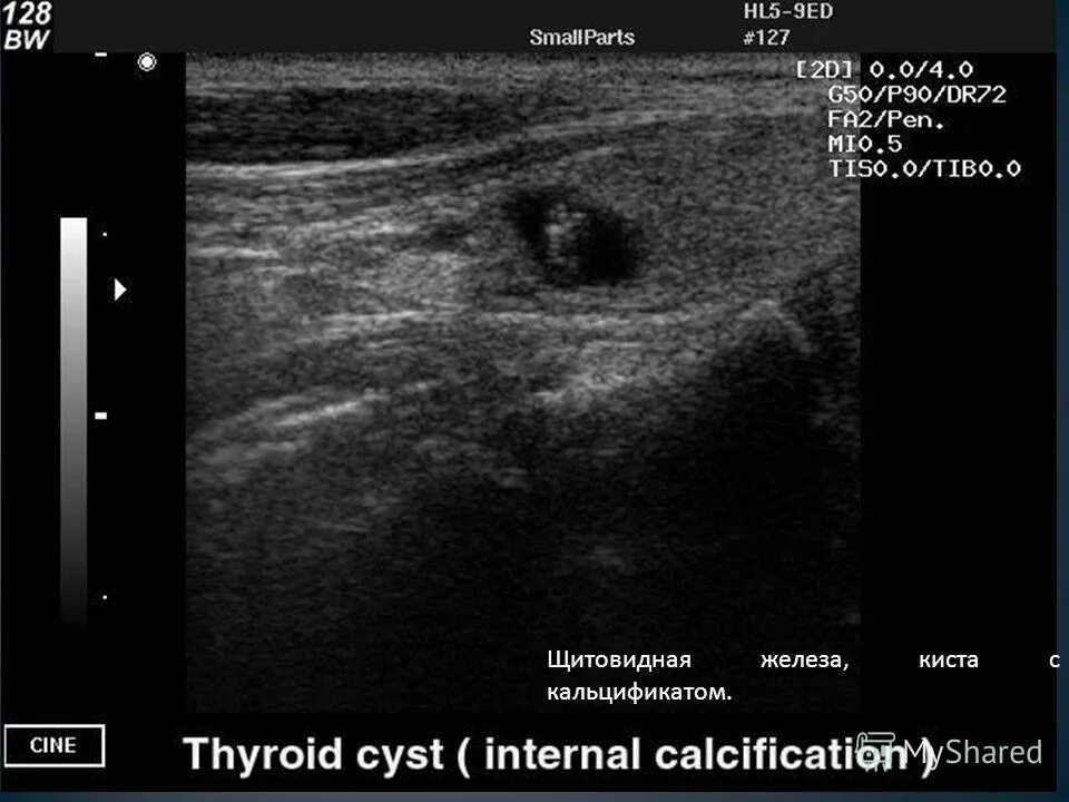 расширение фолликулов щитовидной железы. щитовидная железа гисте. киста перешейка щитовидной железы. коллоидная киста щитовидной железы на узи. кистозные образования в щитовидной железе по узи.