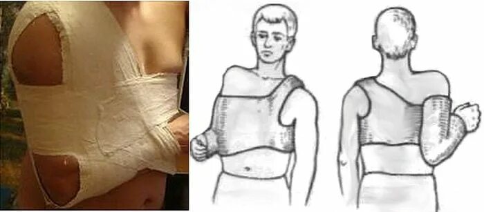 Сколько носить гипс при вывихе. Иммобилизация при переломе локтевого сустава. Гипс при переломе кисти. Сколько носить гипс при вывихе. Сколько носить гипс при вывихе.