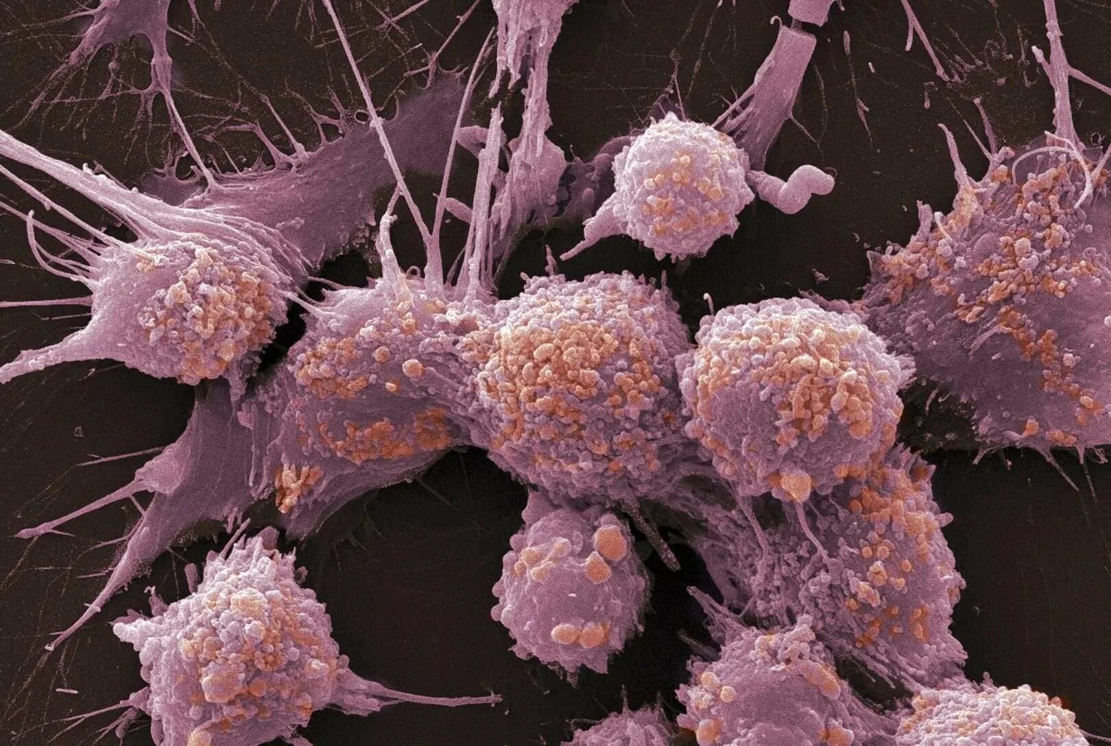 Злокачественная опухоль. Раковые клетки метастазы. Пролиферация раковых клеток. Метастазы злокачественных опухолей. Метастазирование карцином.