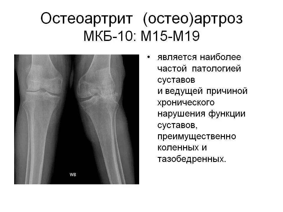 Артрит коленных суставов код по мкб 10. Мкб 10 деформирующий артроз коленного сустава. Артроз тазобедренного сустава код по мкб. Код заболевания доа коленного сустава.