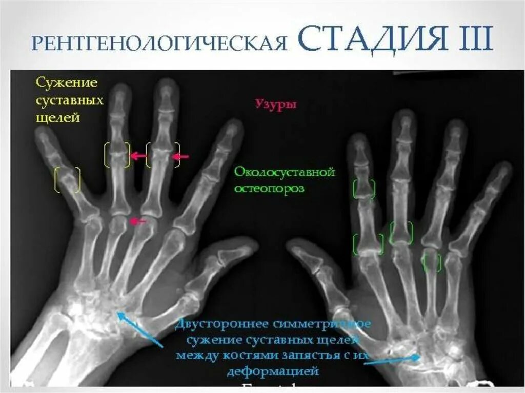 Артрит межфаланговых. Ревматоидный артрит 1 стадия на рентгене. Ревматоидный артрит кисти рентген. Ревматоидный артрит 1 степени рентген. 28 Суставов ревматоидный артрит.