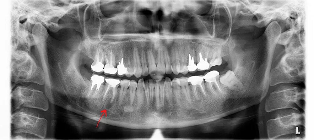 Снимок зубов видное. Ортопантомограмма кариес. Ортопантомограмма киста зуба. Радикулярная киста ОПТГ.
