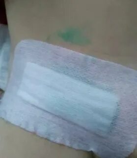 Пластырь после кесарева сечения