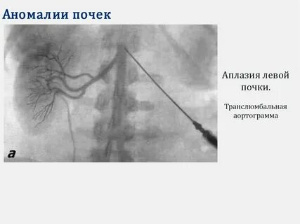 Аплазия