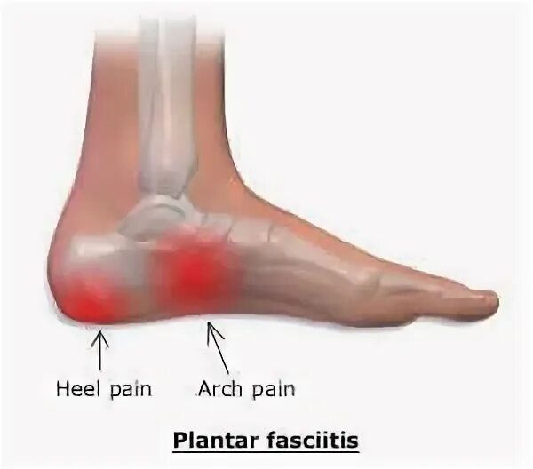 Боли в ступне между пяткой и носком. Боль между пяткой и стопой. Болит стопа с внутренней стороны.