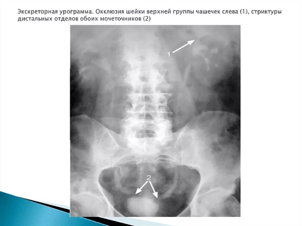 Стриктура мочеточника рентген. Стеноз дистального отдела мочеточника. Дистальный отдел мочеточника. Обоих мочеточников