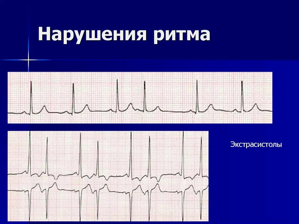 Нарушение р. Нарушение ритма. другие нарушения ритма. структура нарушений ритма. замещающие ритмы и экстрасистолы.