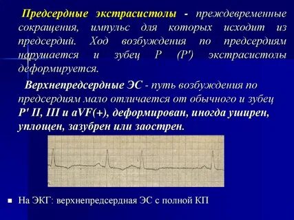 Экстрасистолы