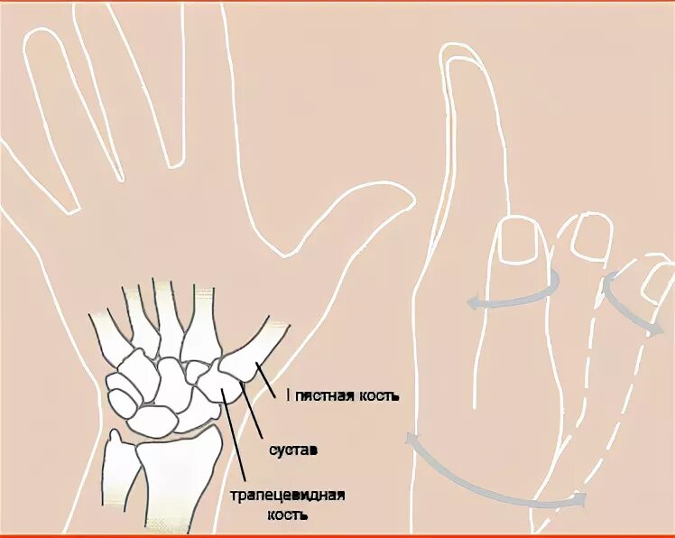 Болит сустав у основания большого пальца руки. Артроз первого запястно-пястного сустава. 1-М запястно-пястном суставе.. Артроз 2 пястно запястного сустава. Локальный статус при артрозе кистей.