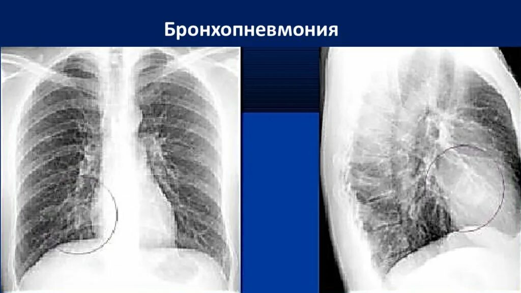Правосторонняя бронхопневмония рентген. Прикорневая пневмония рентген. Лобарная бронхопневмония. Правосторонняя прикорневая пневмония.