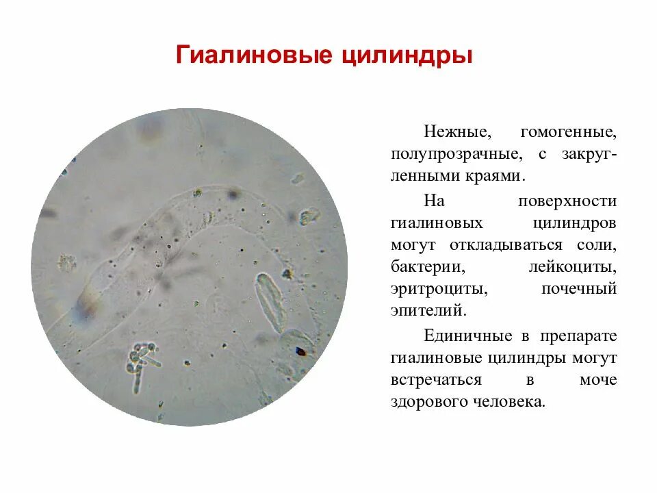 Повышены цилиндры в моче. Микроскопическое исследование осадка мочи микроскоп. При микроскопии осадка мочи гиалиновые цилиндры имеют вид. Норма бактерии микроскопия мочи. Гиалиновые цилиндры микроскопия.